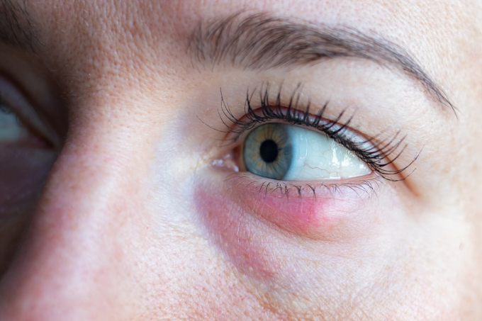 Jęczmień na oku - od czego się robi?