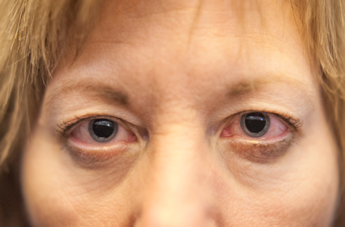 Rozszerzone źrenice