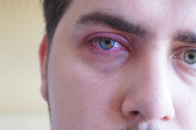 Zapalenie brzeg&oacute;w powiek