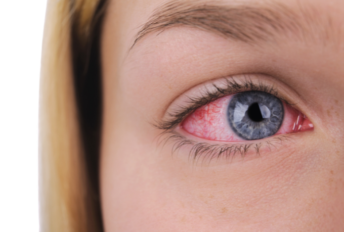 Zapalenie spoj&oacute;wek